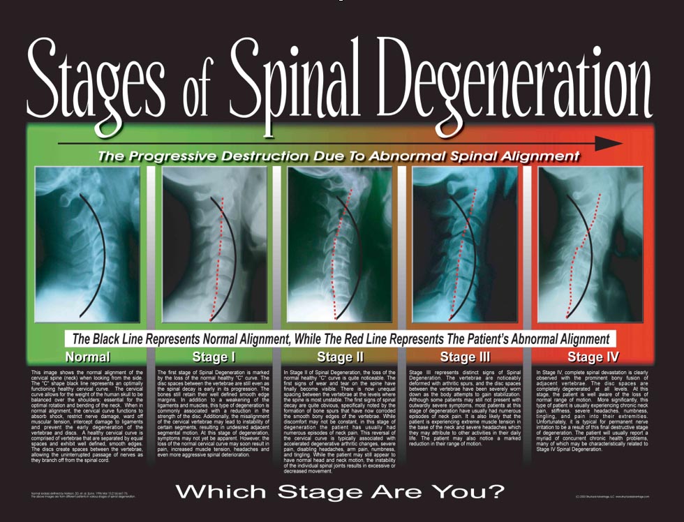 Stages of Spinal Degeneration